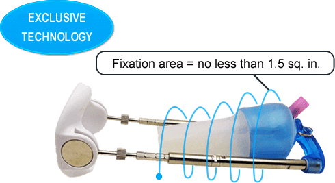 Mens penis extender vacuum trasition system Uvipe GIBRID Penile extender transition system Uvipe GIBRID for any mechanical exetnder